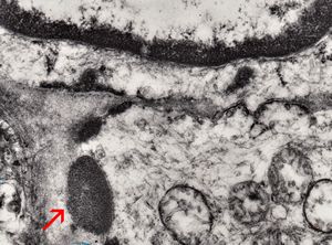 M,71y. | CADASIL accompanied with Alzheimer disease - brain vessel - arrow: granular osmiophilic material (GOM) in basement membrane